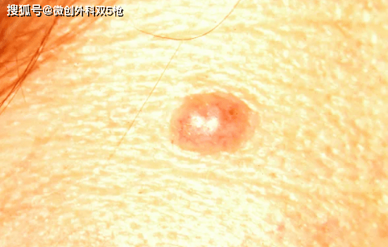 hth华体官方下载app|
身上黑痔小心要了命！掌握ABCDE原则 教你肉眼判断玄色素瘤(图2)