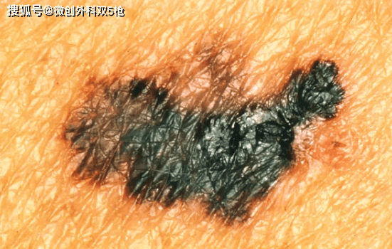 hth华体官方下载app|
身上黑痔小心要了命！掌握ABCDE原则 教你肉眼判断玄色素瘤(图9)